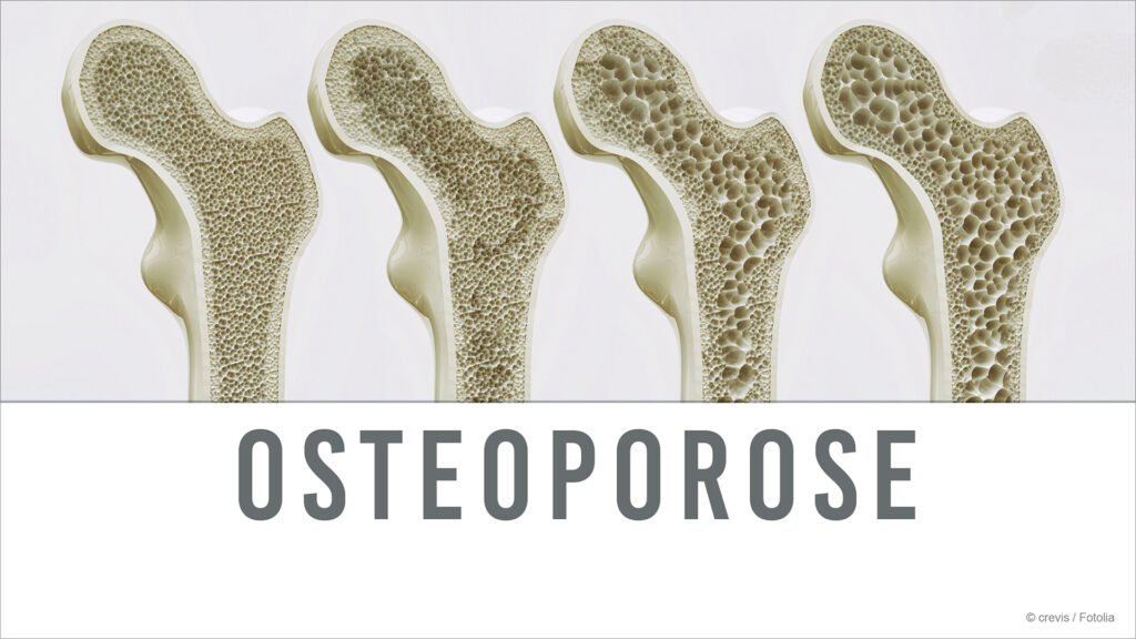 Elithera Aktuell: Osteoporose - Wenn Knochen plötzlich brechen