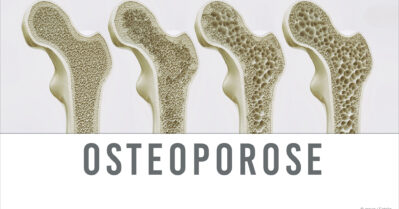 Osteoporose: Wenn Knochen plötzlich brechen