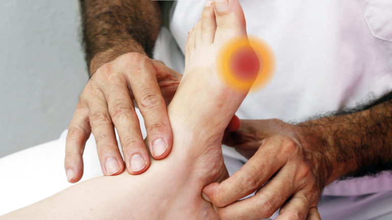 Physiotherapie bei Hallux valgus