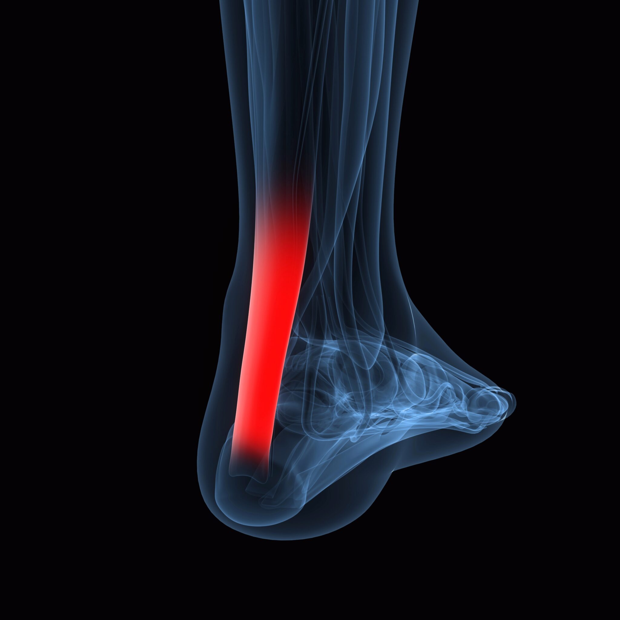 Postoperative Behandlung Nach Stationärer Op Postoperative Behandlung nach Achillessehnen-OP - Elithera